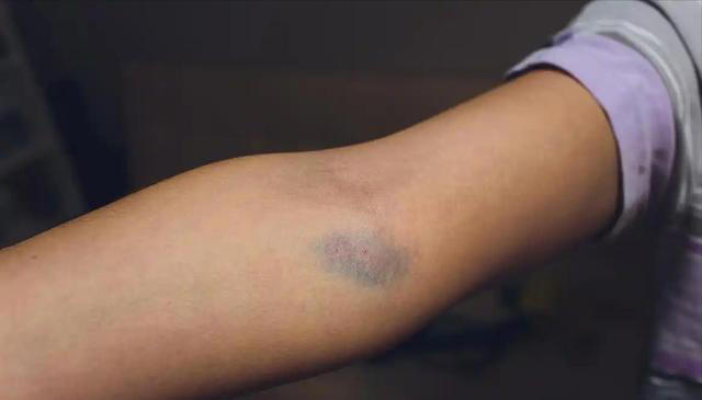 学医后才知道，肝病最危险信号，不是疲劳，而是频繁出现5个症状