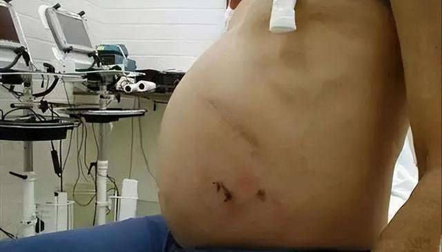 学医后才知道，肝病最危险信号，不是疲劳，而是频繁出现5个症状