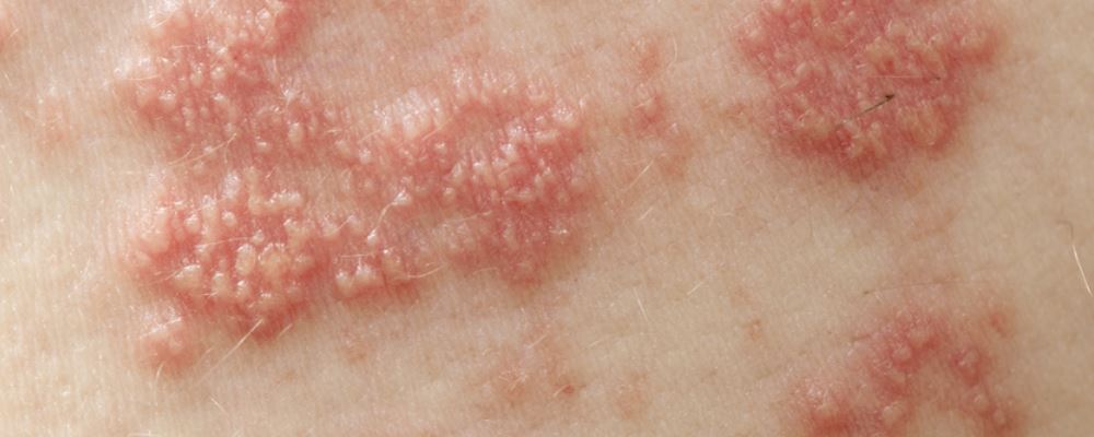 过敏性体质如何调理 如何增强机体免疫力 过敏性体质怎么调理