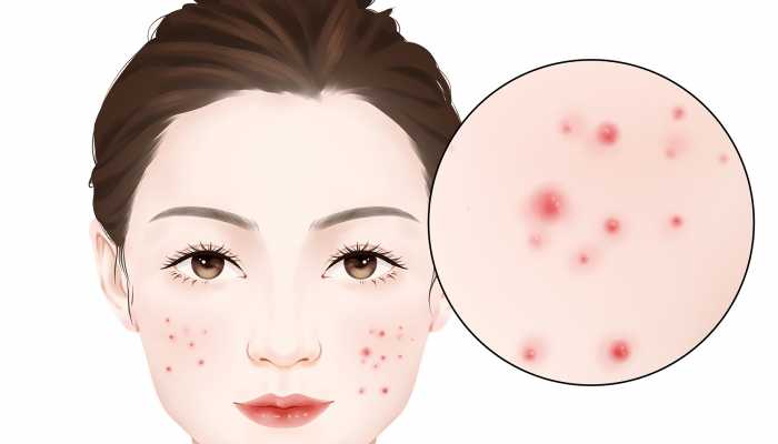 下巴长痘能喝姜水吗 下巴长痘怎么办