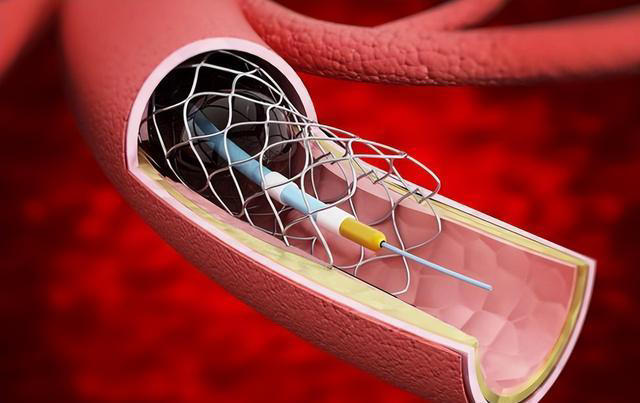 装上心脏支架后，还能活多少年？医生不再隐瞒，说出实情