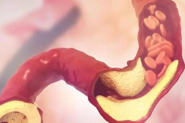 装上心脏支架后，还能活多少年？医生不再隐瞒，说出实情