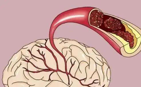 脑梗是“拖”出来的吗？医生：睡觉时若有3个症状，建议引起重视