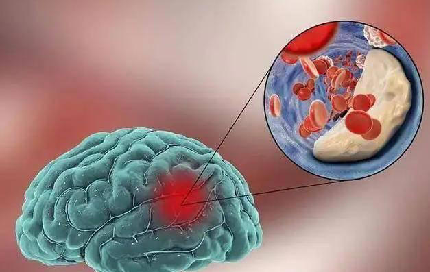 脑梗是“拖”出来的吗？医生：睡觉时若有3个症状，建议引起重视