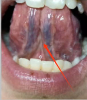 舌下青筋粗紫？别乱吃药！这样做才能化开全身淤血