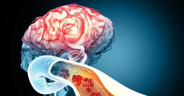 脑供血不足的人，有7个症状！做好这几件事，给脑血管“松绑”