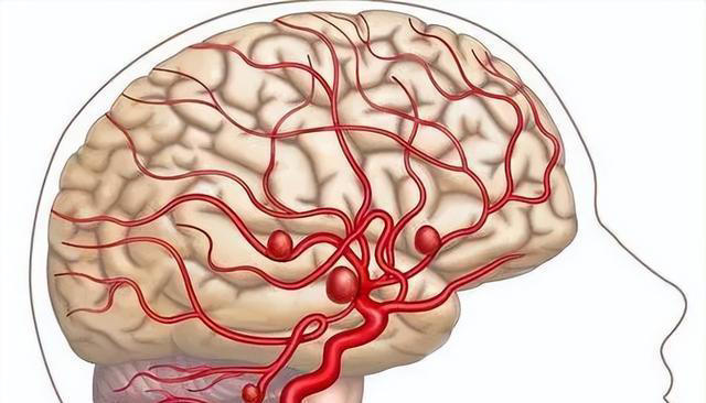 啥是脑供血不足？有什么表现？日常改变8个习惯，保护血管健康！
