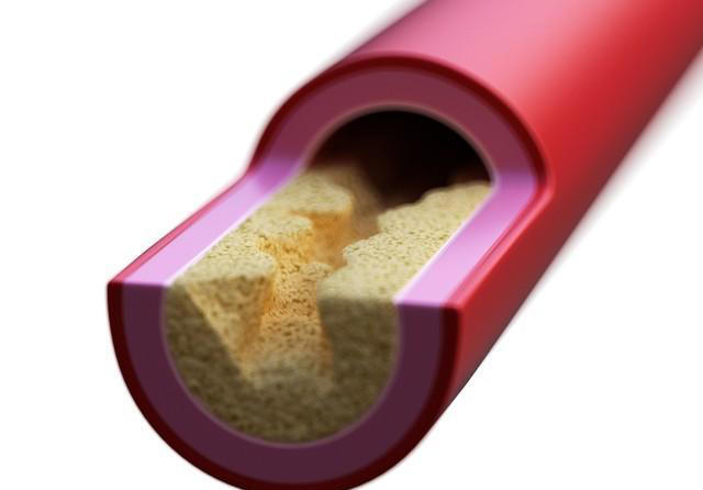 高血压去世的人越来越多？医生劝告：宁可打打牌，也别做这4事