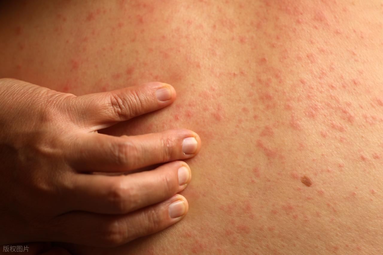痒是大病预警！张文宏提醒：2处发痒，或不是过敏，而是这3病