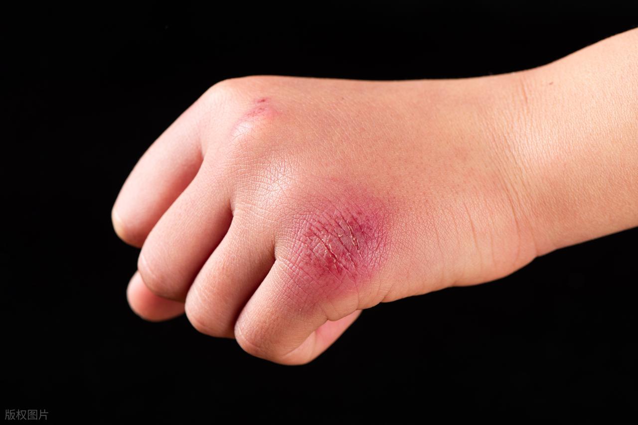 紧急叫停！医生：服用阿司匹林的人，身体出现这3症状必须停药