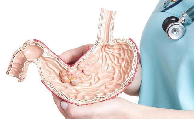 医生：胃癌最危险信号，不是恶心呕吐，而是频繁出现这3种异常