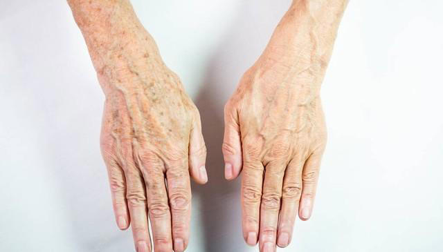 有的人长满“老年斑”，有的却干干净净？医生说出实情