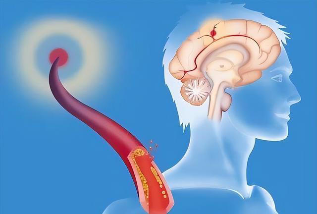 神经内科主任：脑梗最危险信号，不是头晕，而是频繁出现这5异常