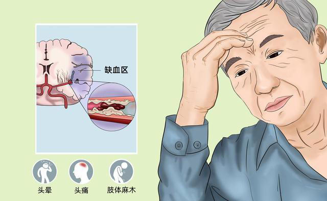 神经内科主任：脑梗最危险信号，不是头晕，而是频繁出现这5异常