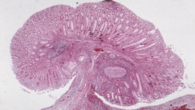 女性总觉得盆腔炎只是小毛病，这3个日常习惯却让它反复发作
