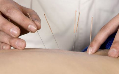 针灸能减肥 注意别走入两大误区