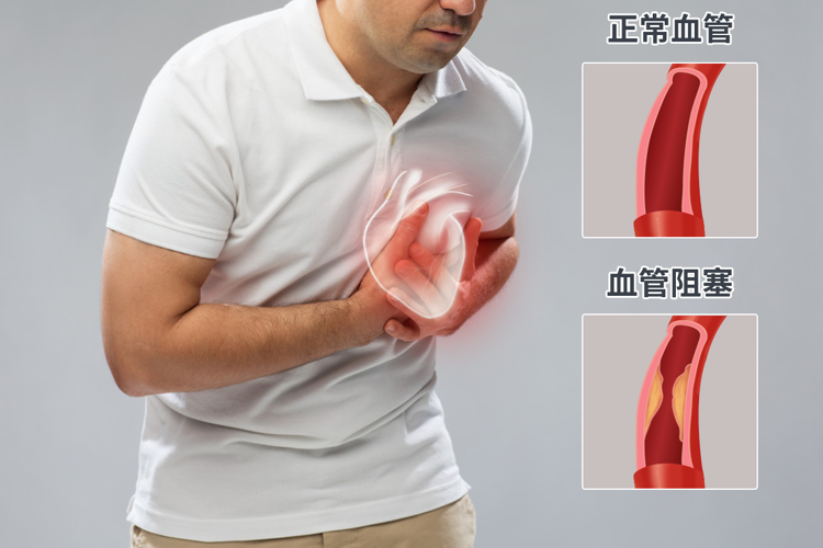 研究发现：血管变硬，或早餐吃错