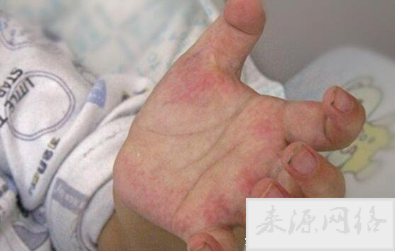 白血病初期小红点图片