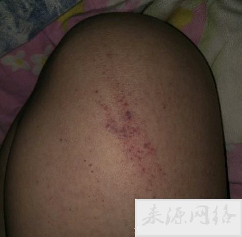 白血病初期小红点图片