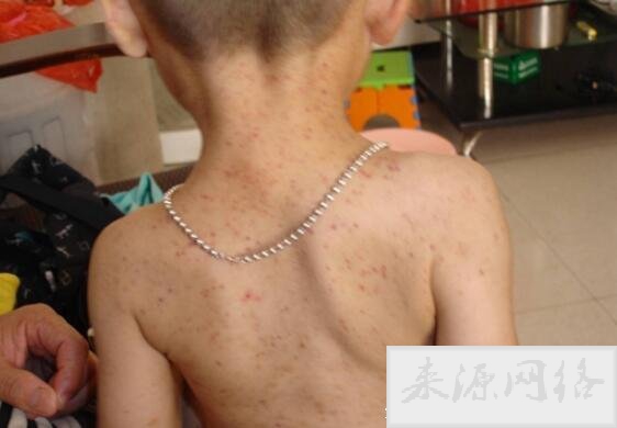 白血病初期小红点图片