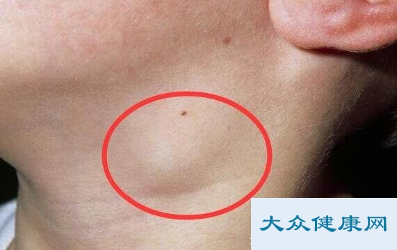 脖子淋巴癌早期症状图片？