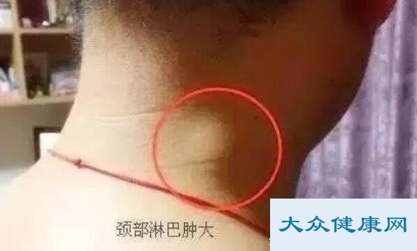 脖子淋巴癌早期症状图片？