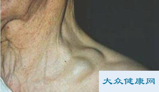 脖子淋巴癌早期症状图片？