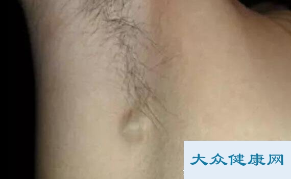 脖子淋巴癌早期症状图片？