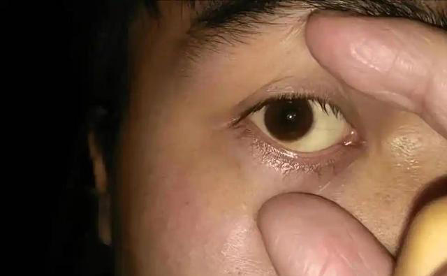学医后才知道，肝病最危险信号，不是疲劳，而是频繁出现4个症状