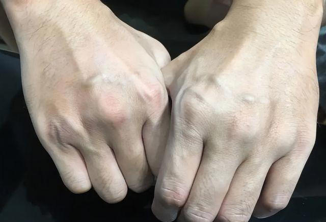为何有些人手臂“青筋暴起”，有人却看不到“青筋”，看完明白了