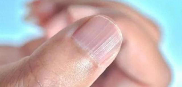 指甲盖上有竖纹，是老一辈说的肝脏不好吗？可能是体内缺这些了